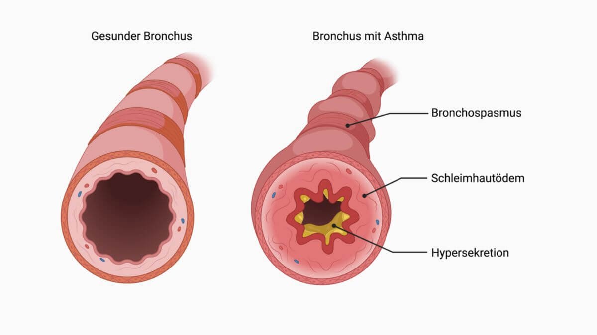 was ist asthma