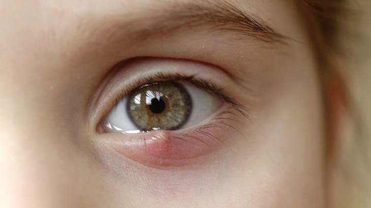 gerstenkorn im auge