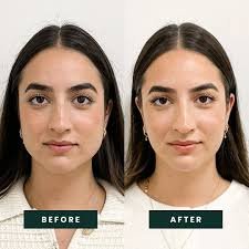 masseter botox vorher nachher