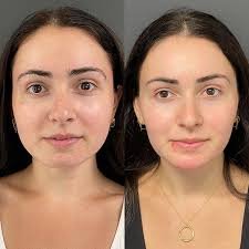 masseter botox vorher nachher