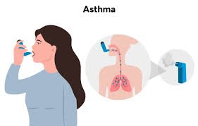 was ist asthma